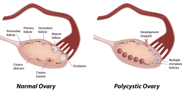 Polycystic ovaries