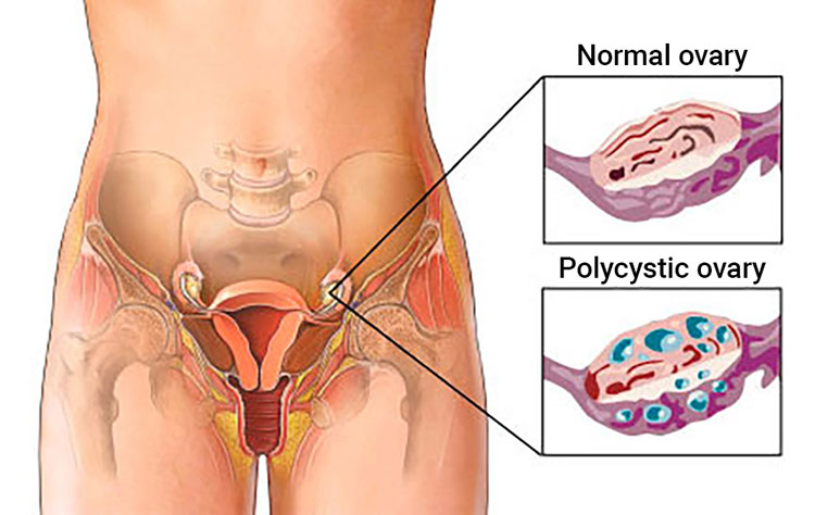 Polycystic ovaries