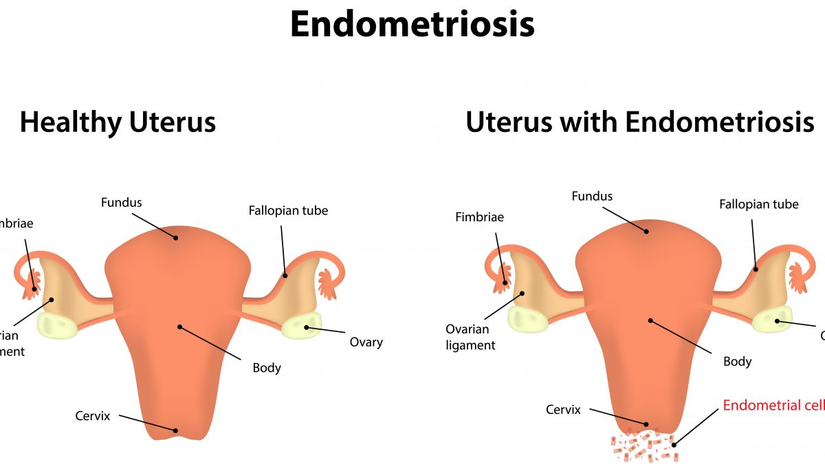 Endometriosis