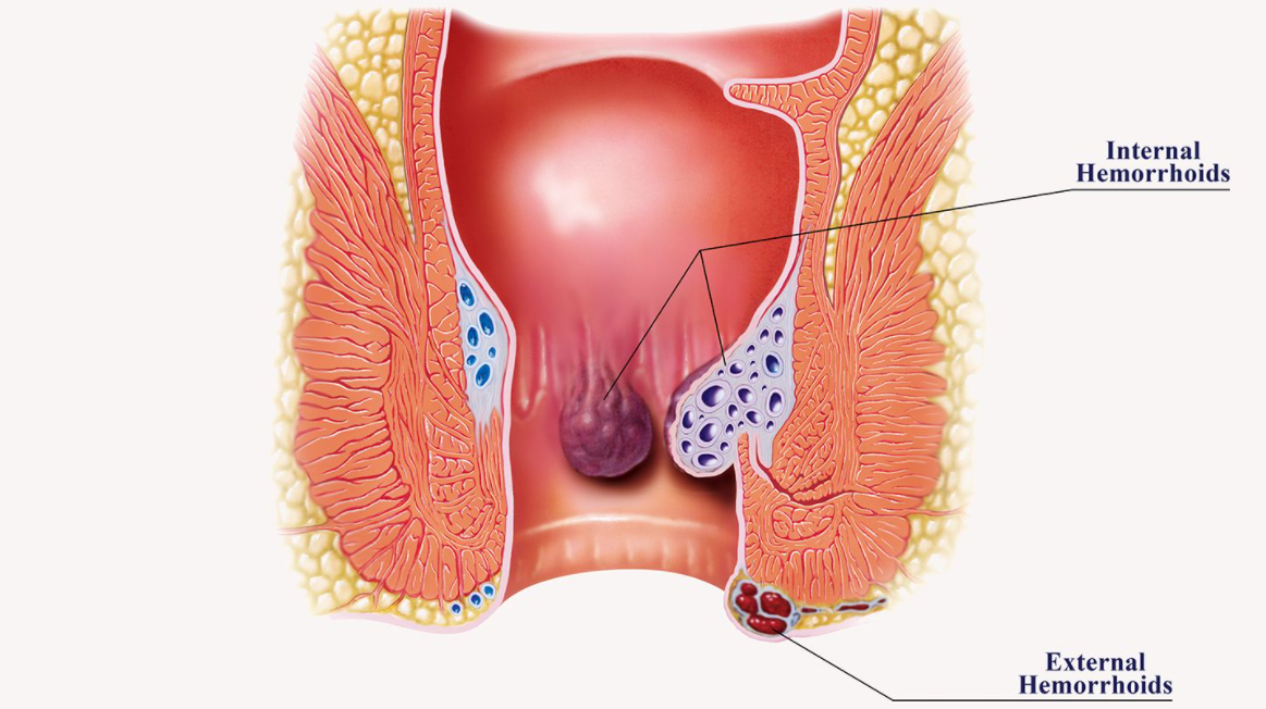 Hemorrhoids