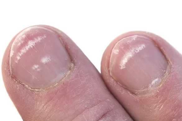 Spots on your nails