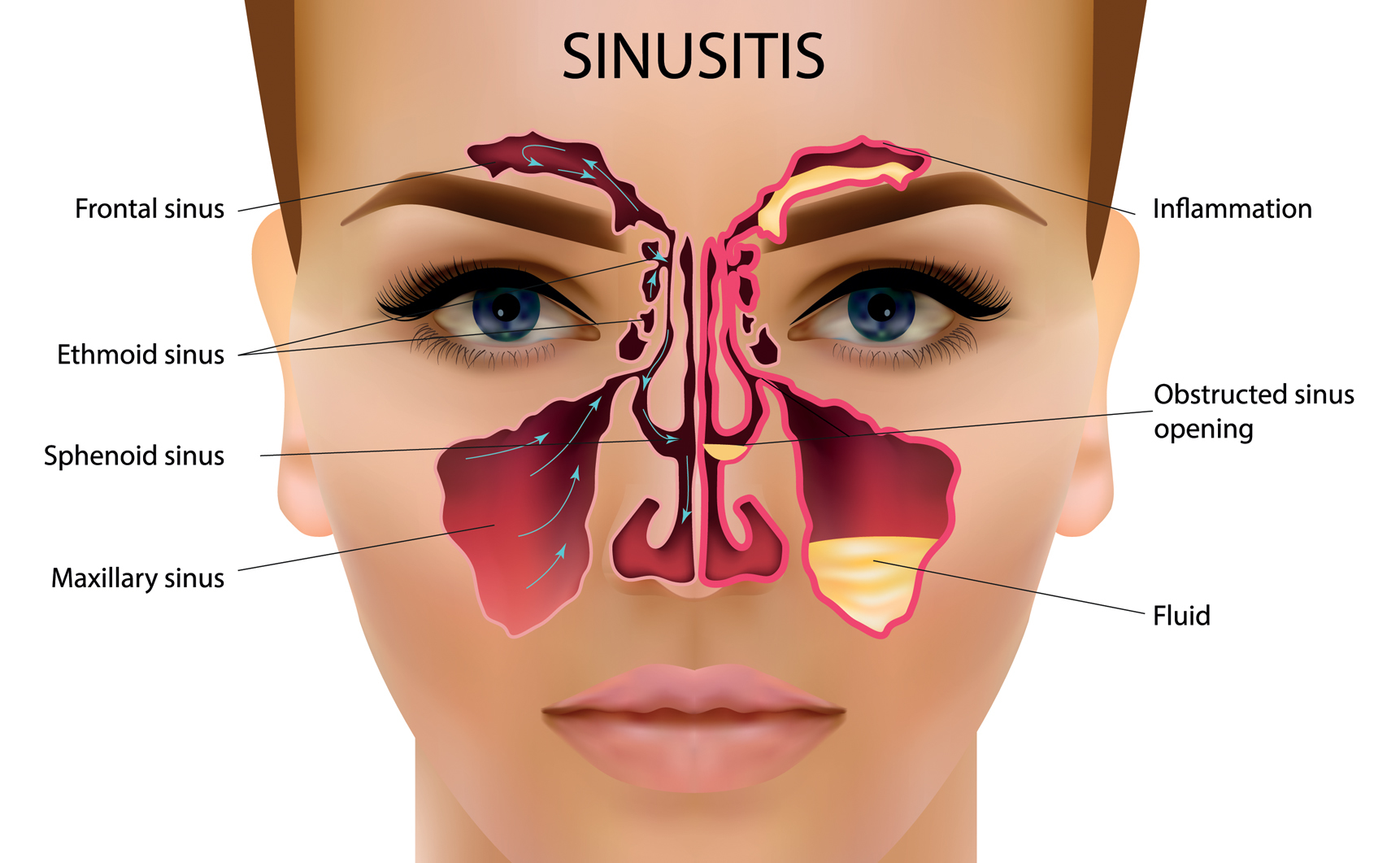 Chronic sinusitis