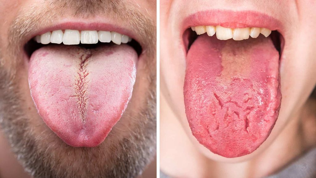 3 Things Your Tongue Is Trying To Reveal About Your Health My Healthygram