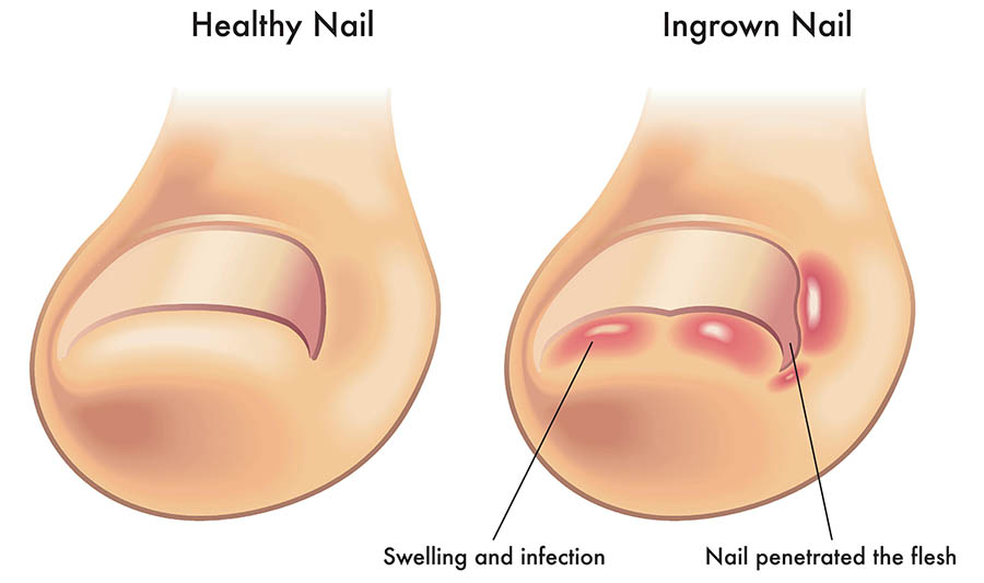 ingrown toenails