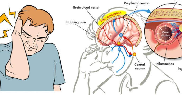 migraines