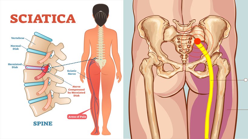 sciatic nerve