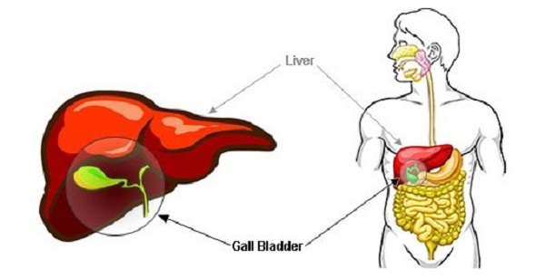 gallbladder stones