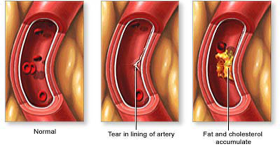 cholesterol levels