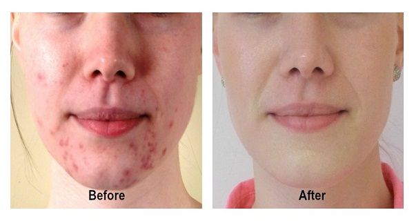 facial acne and pimples