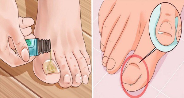 Ingrown toenail