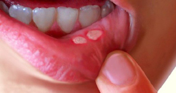 Mouth ulcers