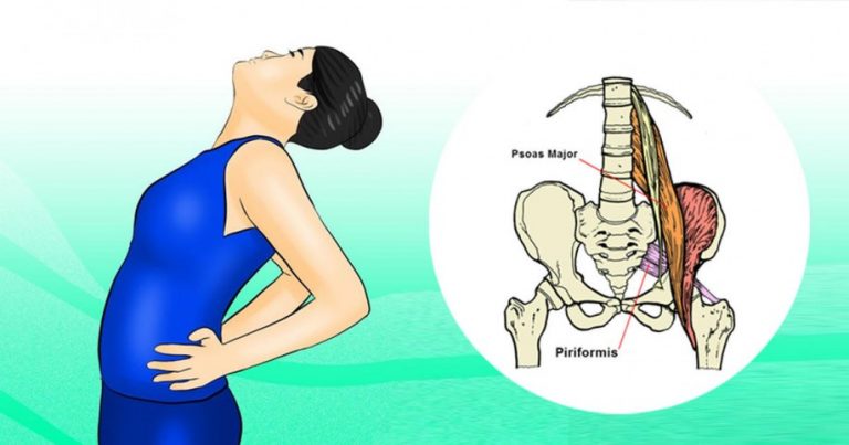 Sciatica pain