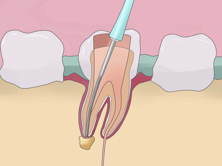 root canals