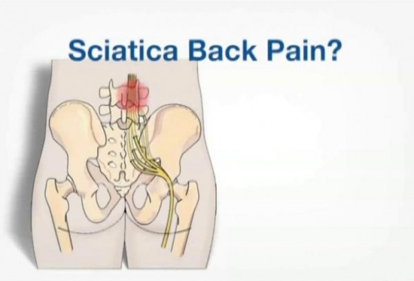 sciatica nerve