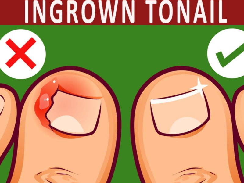 ingrown toenails and warts