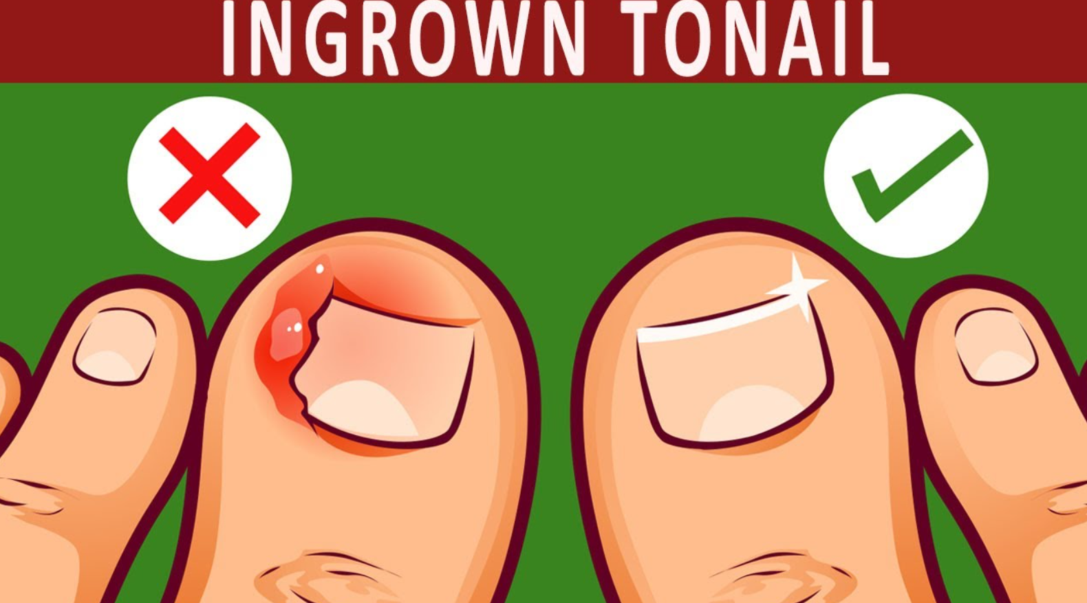 ingrown toenails and warts