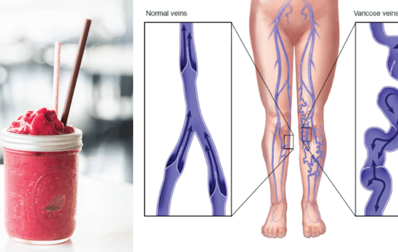 Varicose veins