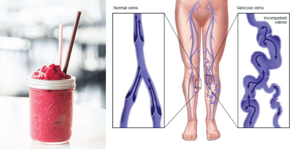 Varicose veins