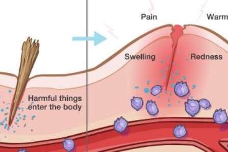 inflammation