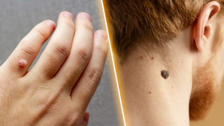 Skin tags