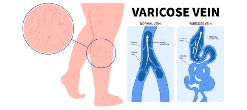 Varicose veins