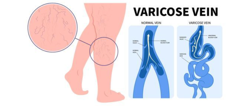 Varicose veins