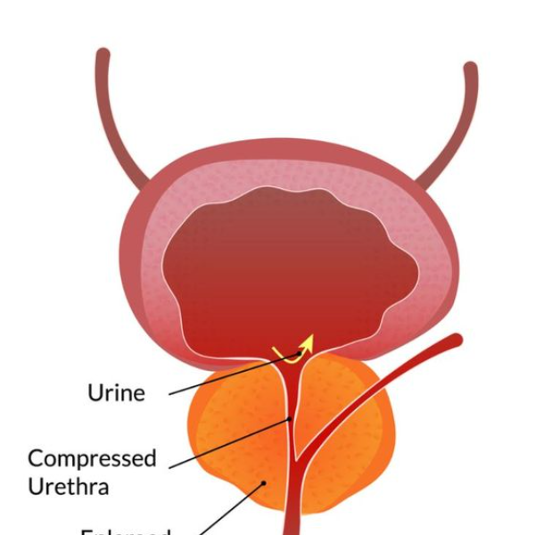 prostate health