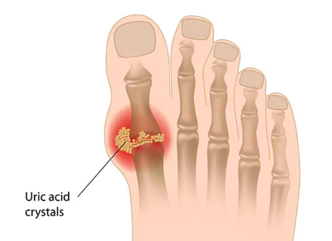 uric acid