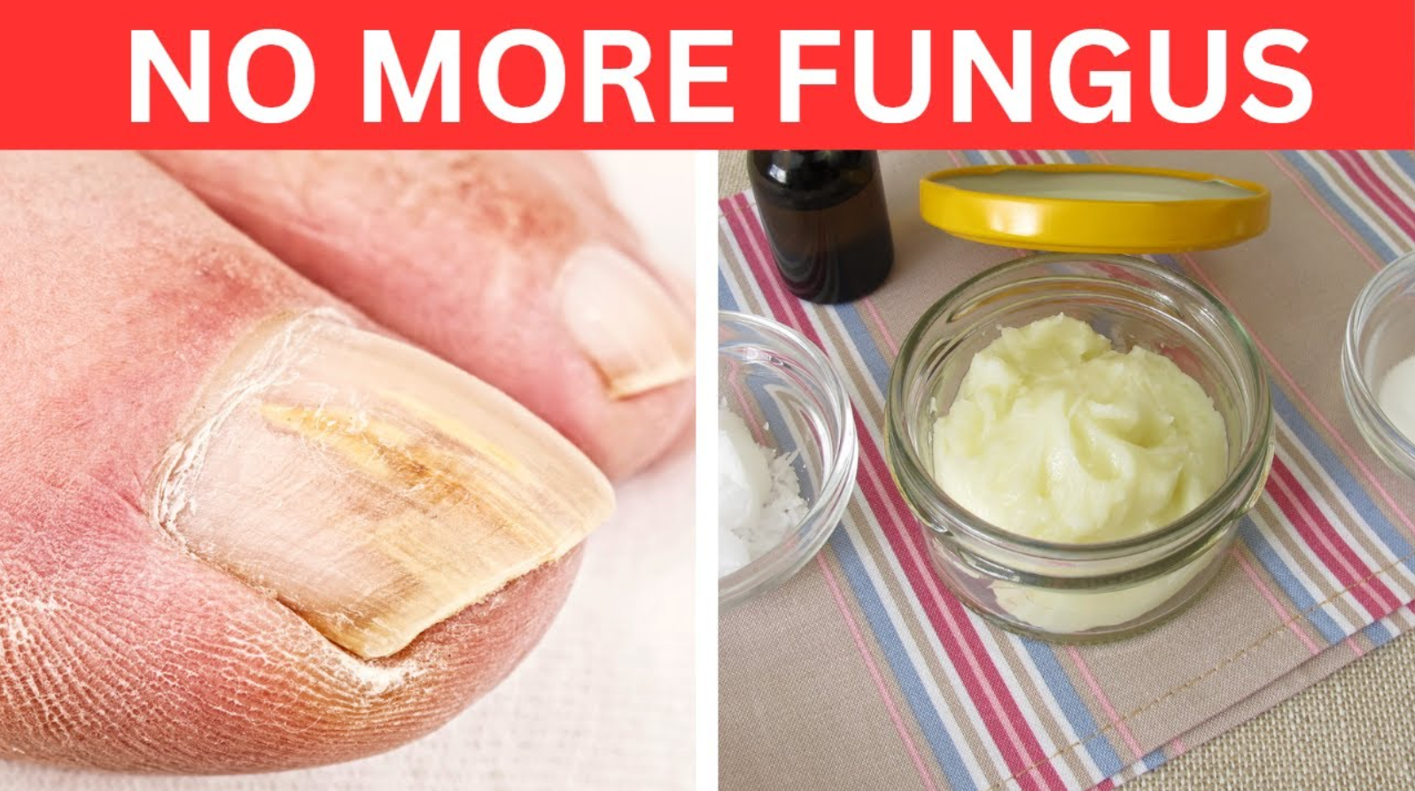 Nail fungus