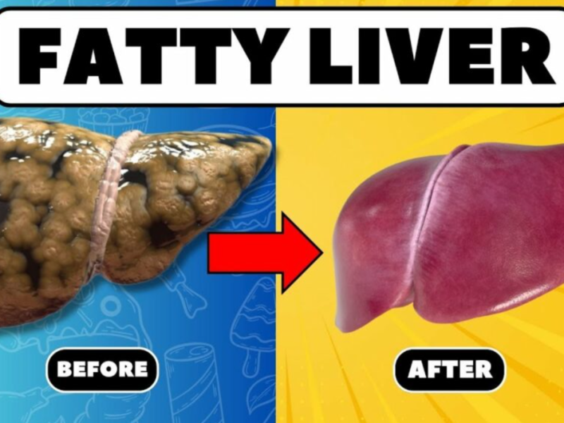 fatty liver