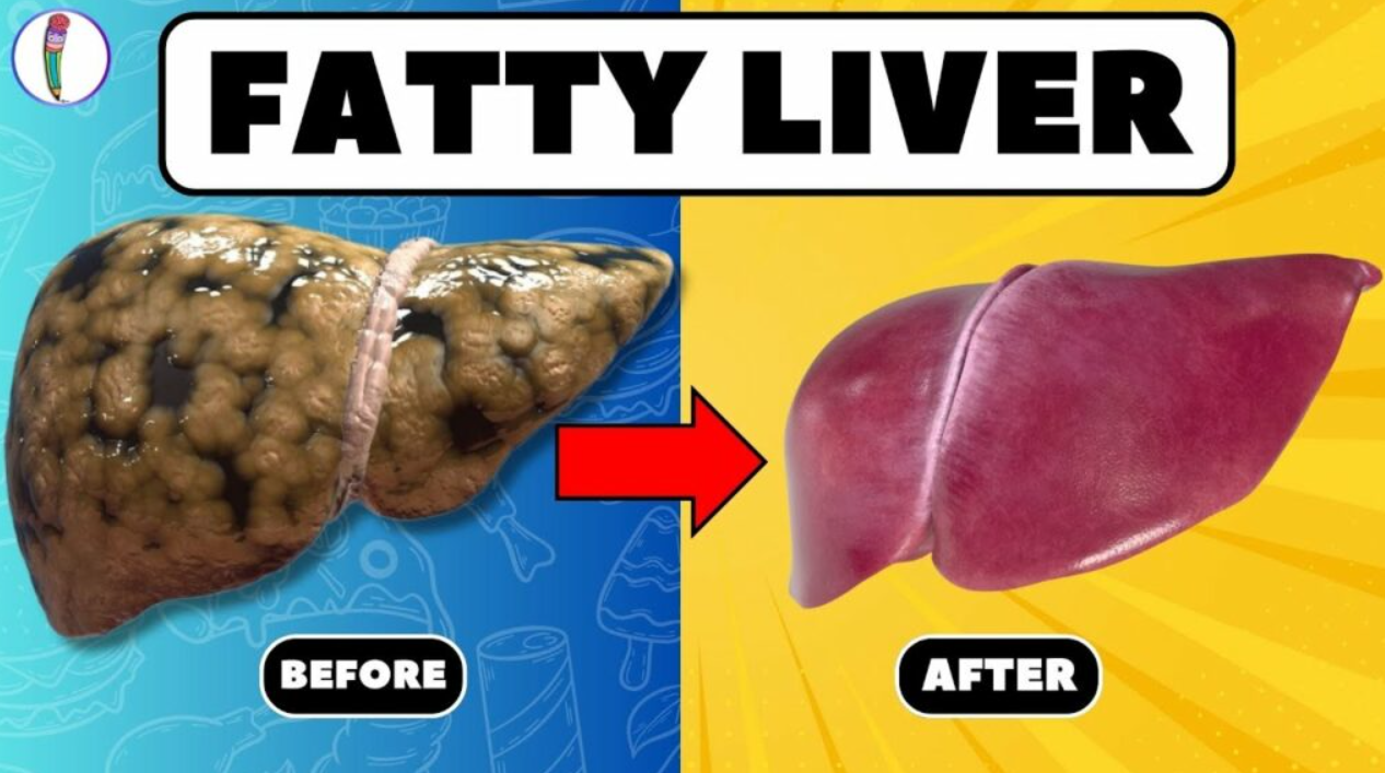 fatty liver